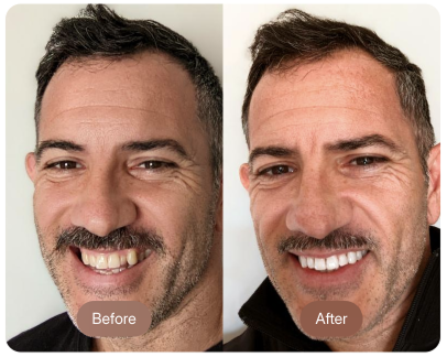 Before and after - man with mustache