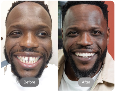 Before and after - man with beard
